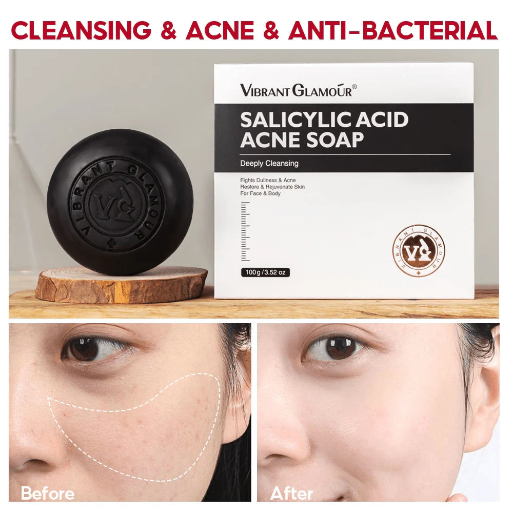 Vibrant Glamour Salicylic Acid Acne Soap - 100g - Glow Getter Beauty