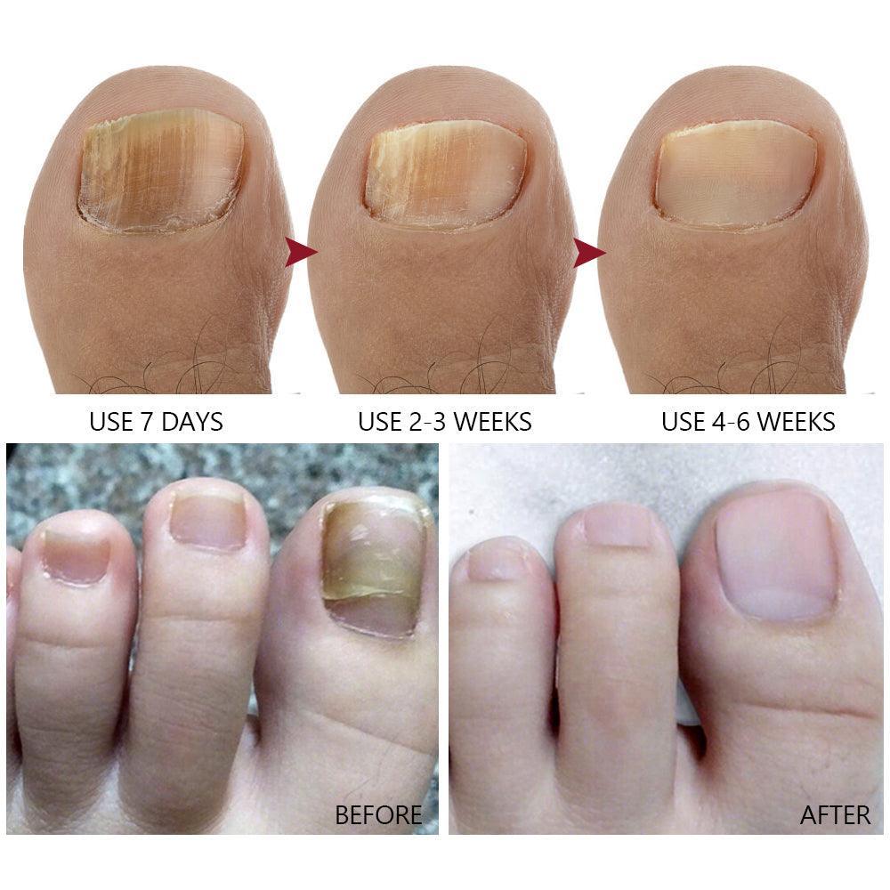Vibrant Glamour Nail Repair Cream Anti Fungal Nails Repair Nourishing- 20g - Glow Getter Beauty